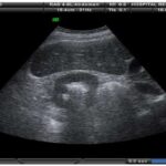 Qué es el ultrasonido urologico