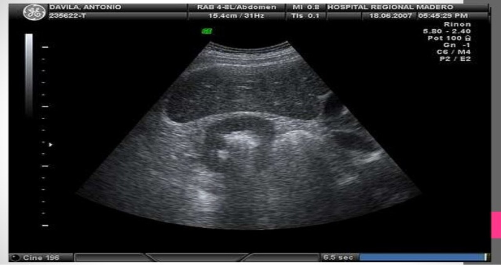 Qué es el ultrasonido urologico