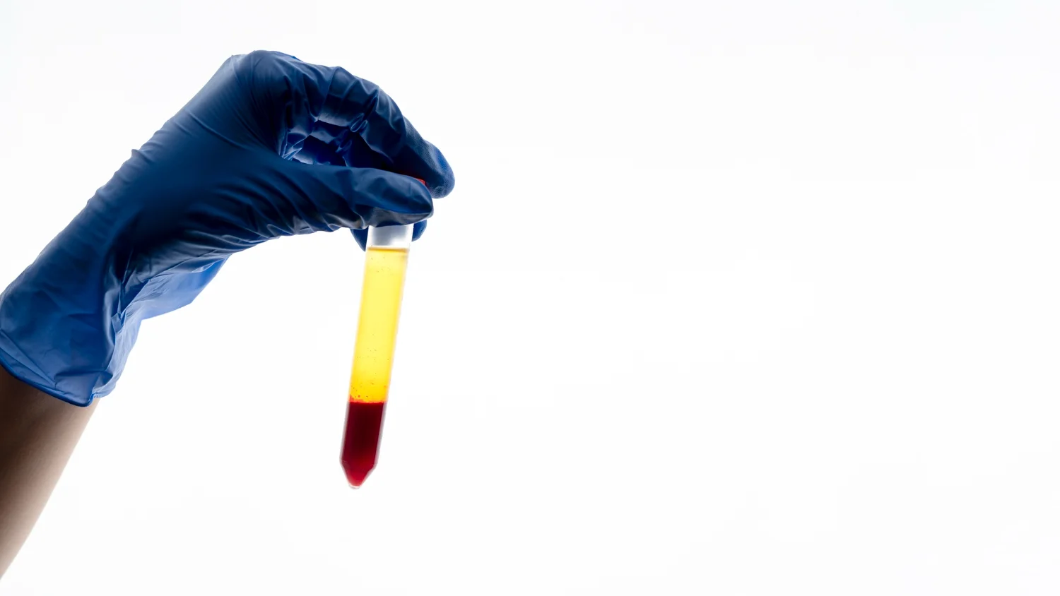 Que causa la sangre en la orina