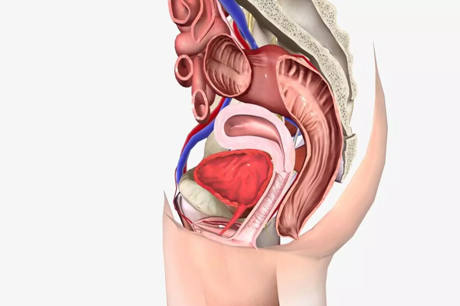 Cistocele