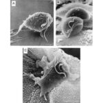 Síntomas de la Tricomoniasis