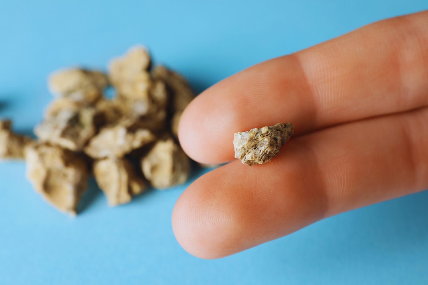 cómo se forman las piedras en los riñones