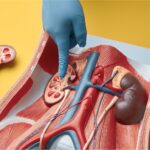 cómo saber si tengo piedras en los riñones