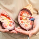 expulsar piedras del riñón naturalmente