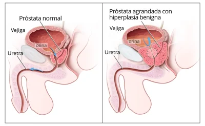 BPH_es-hiperplasia_benigna_de_prostata BPH_es-hiperplasia_benigna_de_prostata